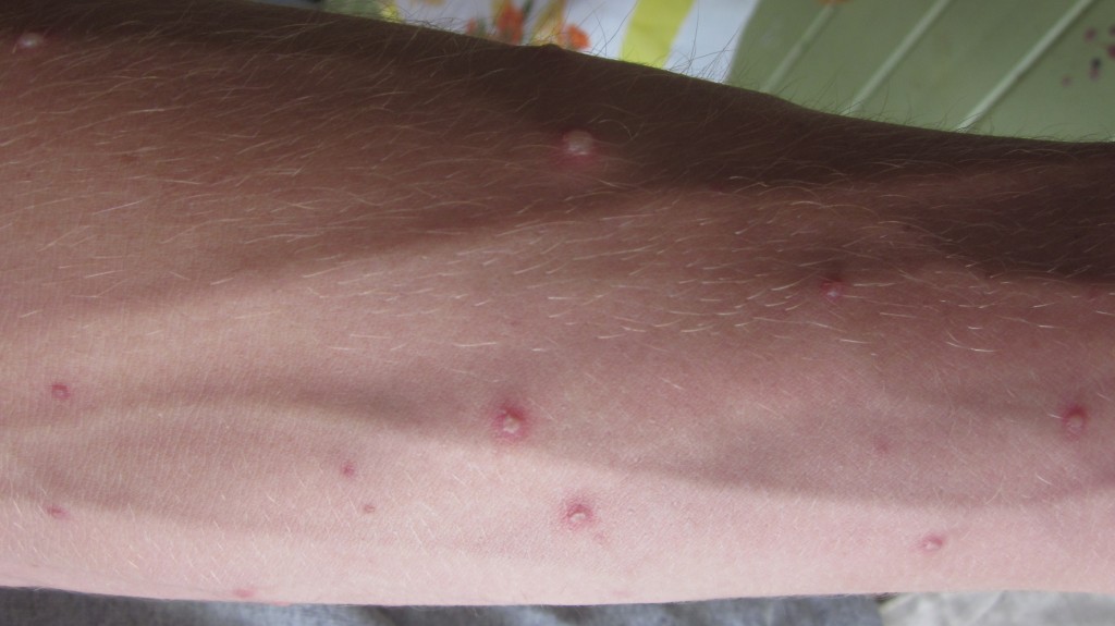 Here are the chicken pox on Timothy's arm.