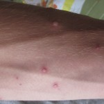 Comfort Measures: Natural itch relief for Chicken Pox 